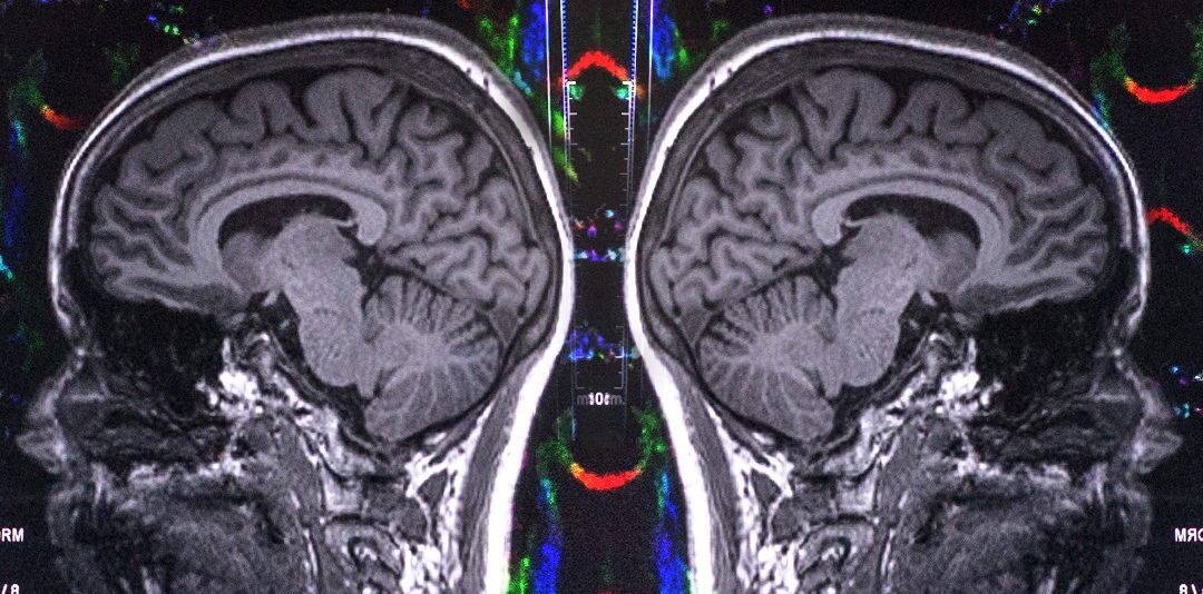 brain scan