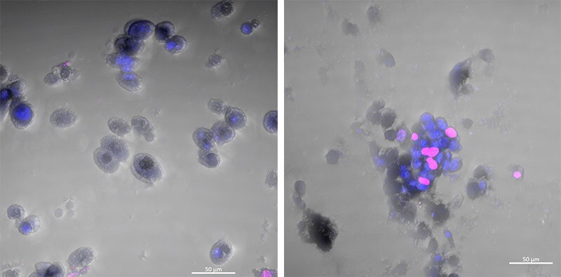 This confocal microscope image shows dormant breast cancer cells on the left. On the right, the dormant breast cancer cells shown in pink are reactivating, i.e., waking up.